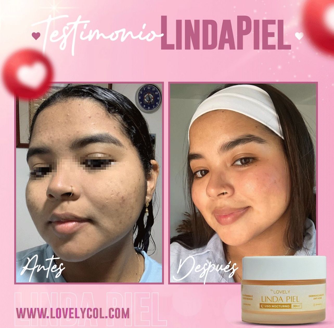 LINDA PIEL (manchas y acné )