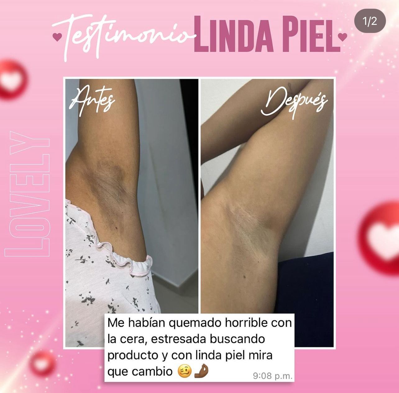 LINDA PIEL (manchas y acné )