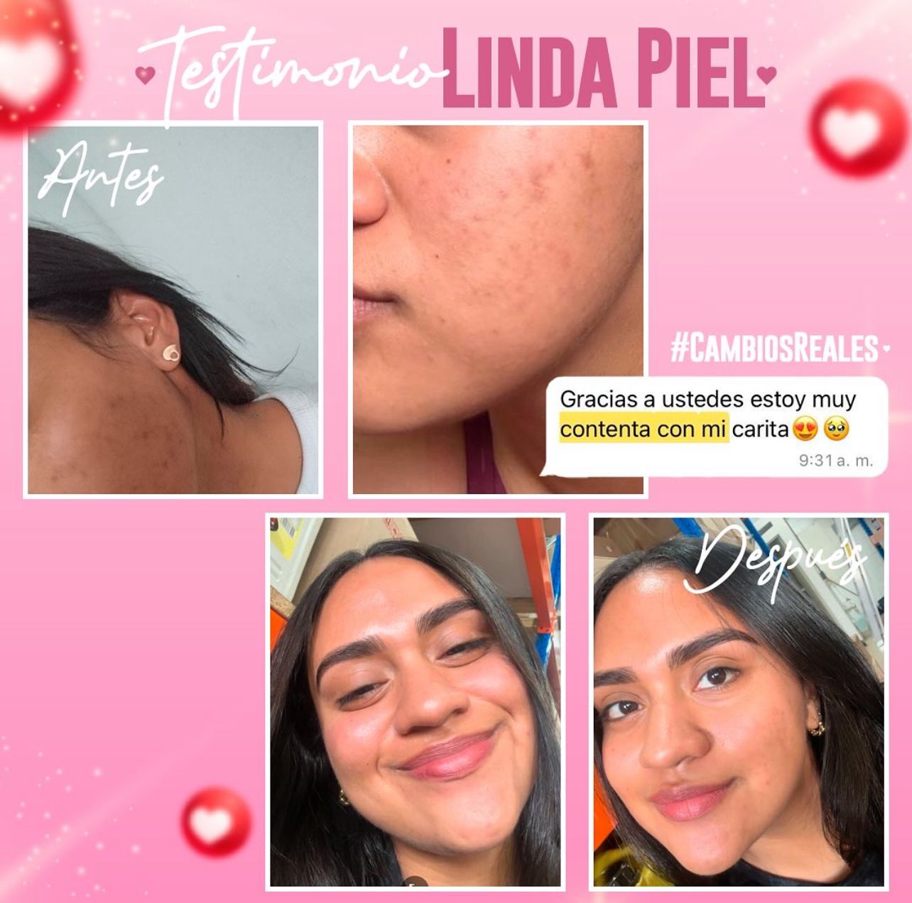 LINDA PIEL (manchas y acné )